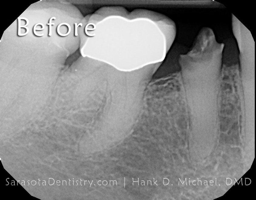 Dental Implant Smile Case #3 — view 1
