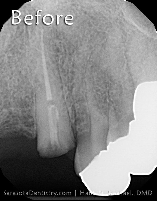 Dental Implant Case #5