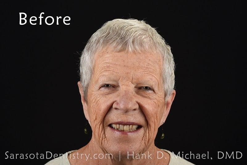 Porcelain Crown Makeover Before & After