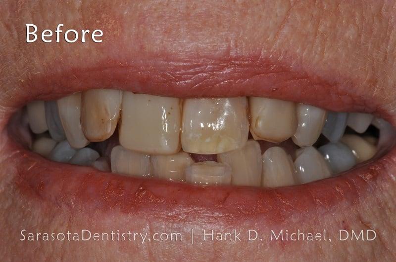 Porcelain Crown Makeover Before & After — view 5