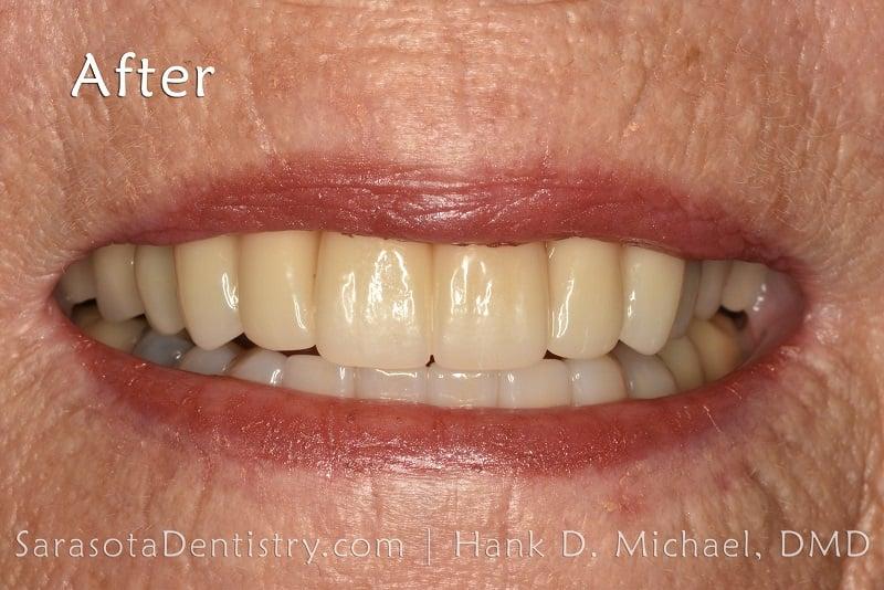 Porcelain Crown Makeover Before & After — view 6