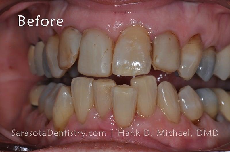 Porcelain Crown Makeover Before & After — view 3