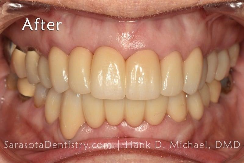 Porcelain Crown Makeover Before & After — view 4