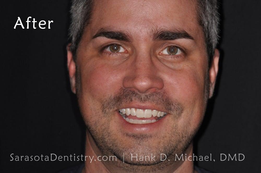 Straight Teeth with Invisalign Case Study #11 — view 2