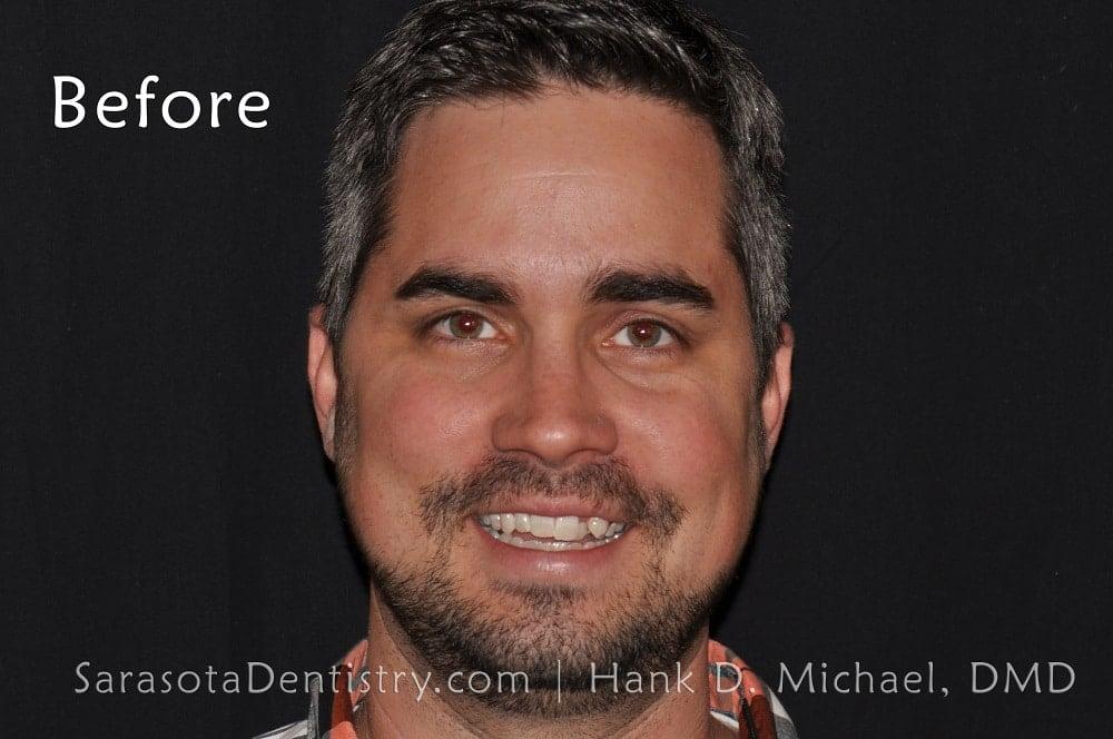 Straight Teeth with Invisalign Case Study #11