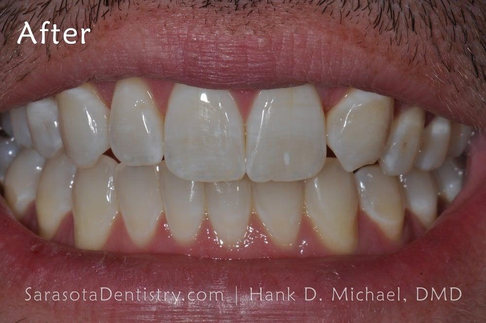 Straight Teeth with Invisalign Case Study #11 — view 6