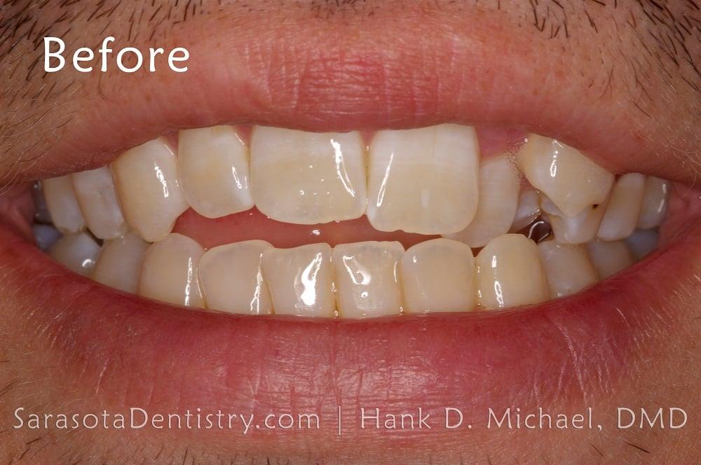 Straight Teeth with Invisalign Case Study #11 — view 5