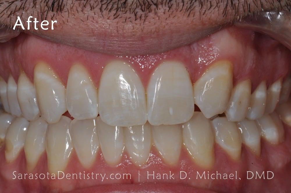 Straight Teeth with Invisalign Case Study #11 — view 4
