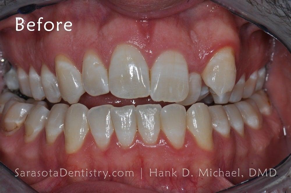 Straight Teeth with Invisalign Case Study #11 — view 3