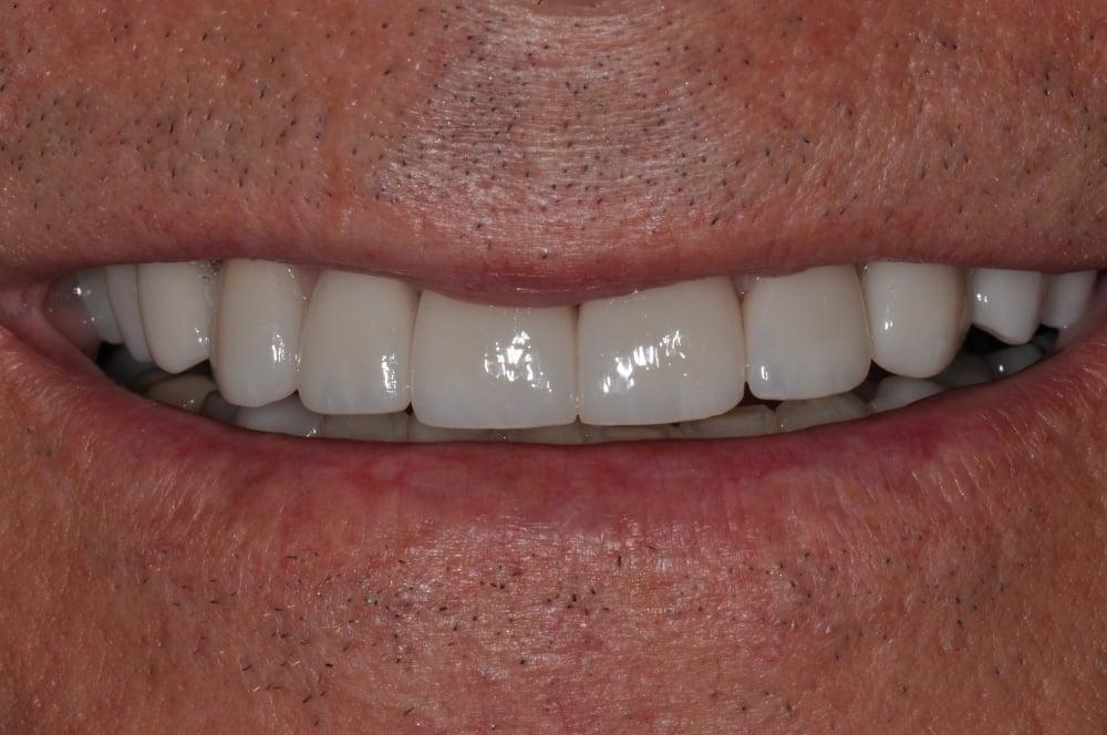 Smile Makeover with Porcelain Crowns Case #12 — view 6