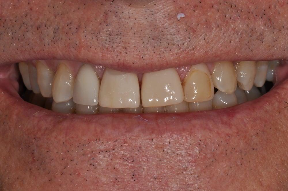 Smile Makeover with Porcelain Crowns Case #12 — view 5