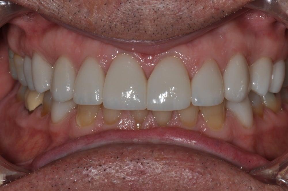 Smile Makeover with Porcelain Crowns Case #12 — view 4