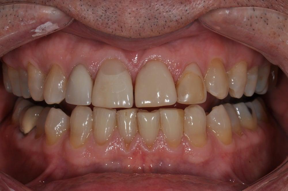 Smile Makeover with Porcelain Crowns Case #12 — view 3