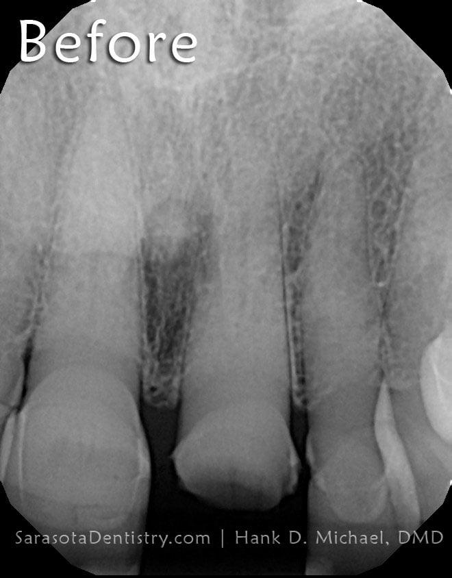 Fractured Tooth Treated with Immediate Dental Implant