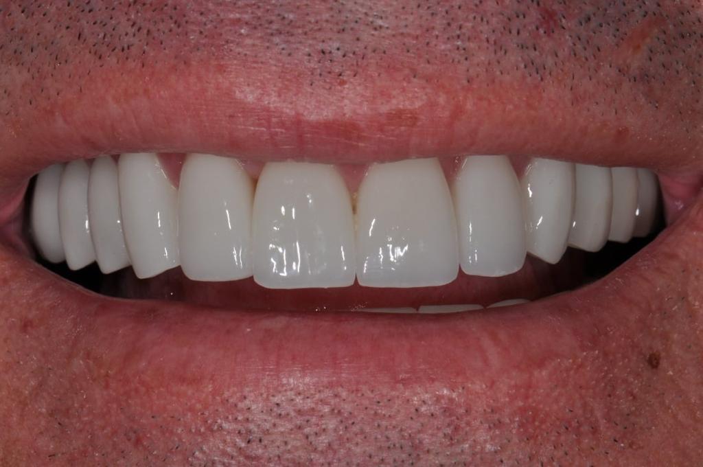 Porcelain Crown Smile Makeover #7 — view 7