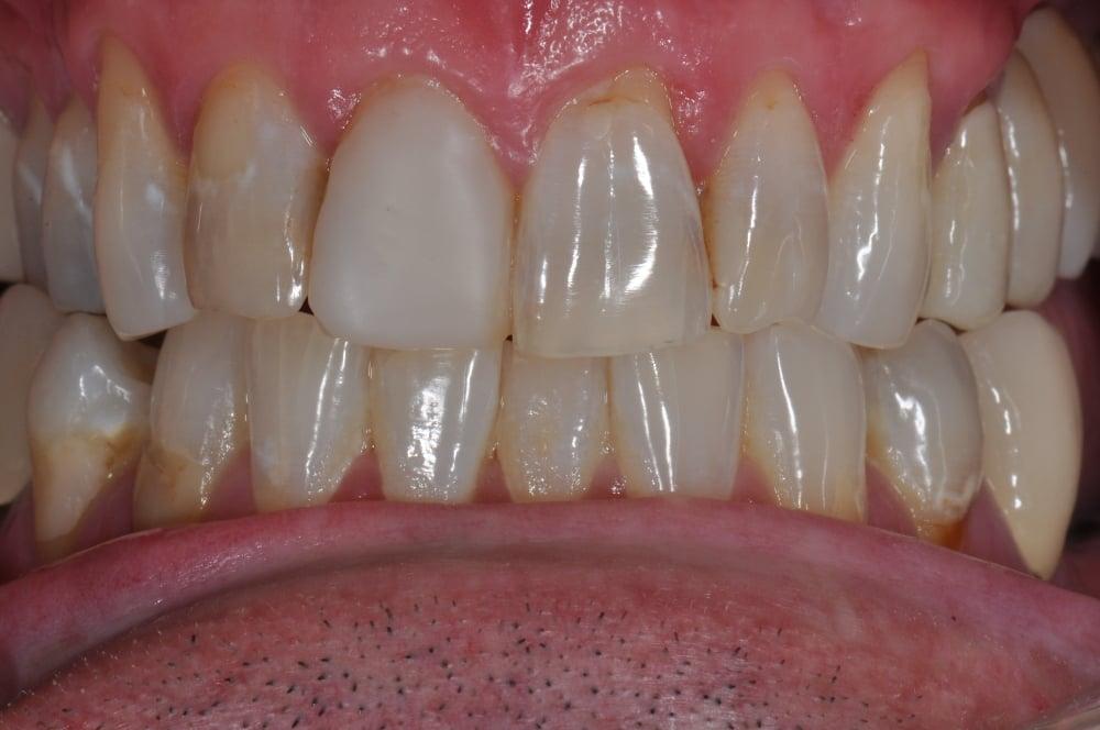 Porcelain Crown Smile Makeover #7 — view 4