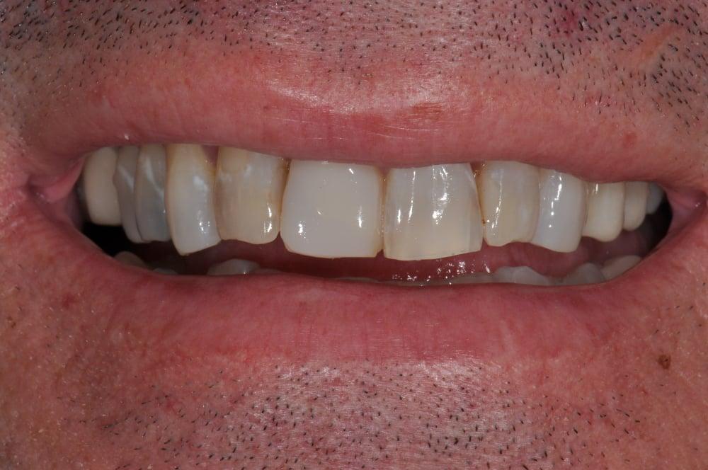 Porcelain Crown Smile Makeover #7 — view 6