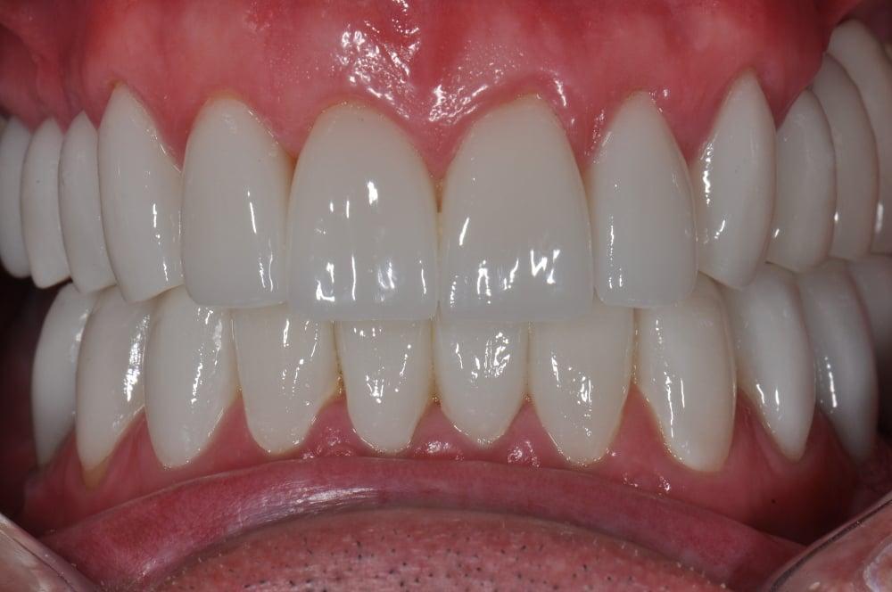Porcelain Crown Smile Makeover #7 — view 5