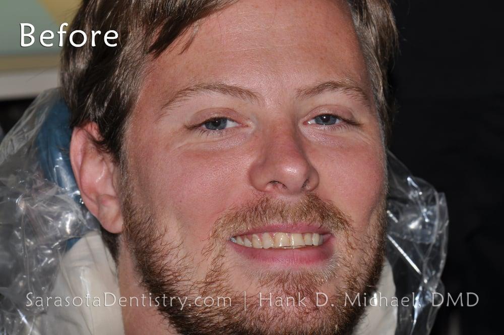 Smile Makeover with Porcelain Crowns & Caps