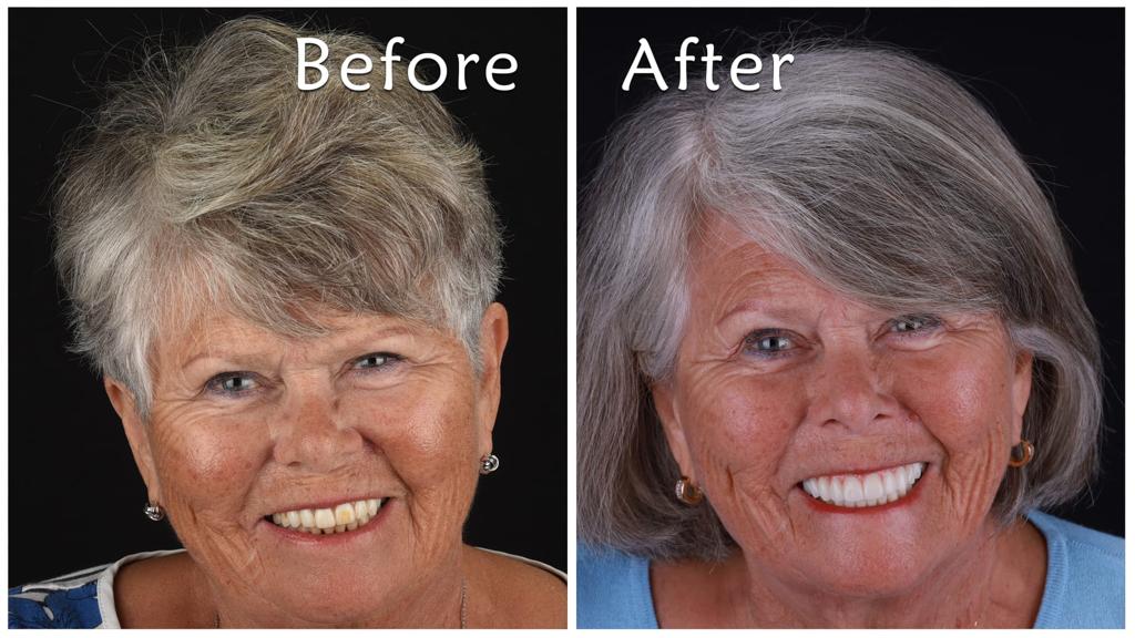 All-on-4 Dental Implants