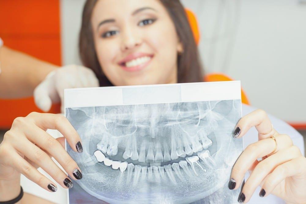 Implant-Supported Dentures