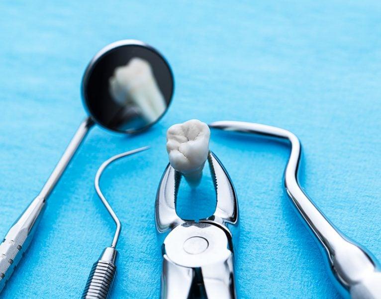 Tooth Extraction