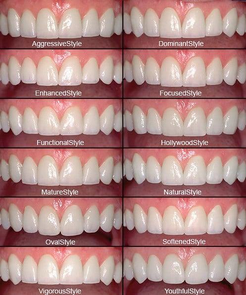 Porcelain Veneers