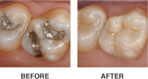 CEREC Same-Day Crowns