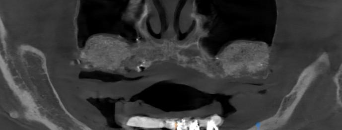 CBCT scan after sinus augmentation showing new grafted bone rebuilt beneath both maxillary sinuses