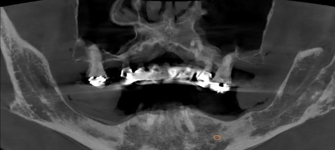 CBCT scan before sinus augmentation showing insufficient bone height beneath the maxillary sinuses