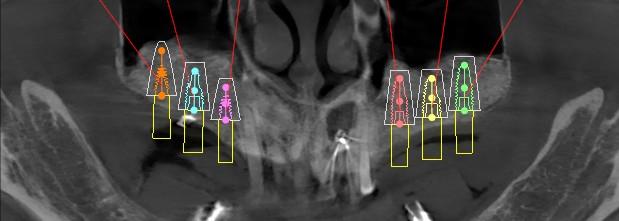 Digital implant planning on a CBCT scan showing dental implants positioned in newly grafted upper jaw bone
