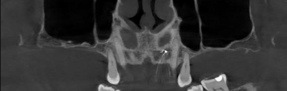 Coronal CBCT slice used to measure bone height beneath the maxillary sinus before a sinus lift