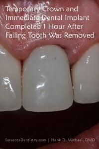 immediate dental implant