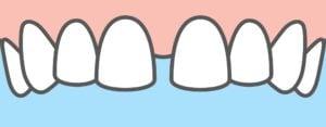 diastema gap in front teeth