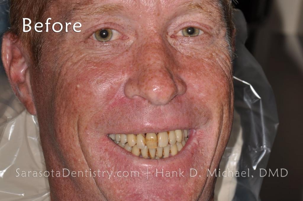 Full Arch Prettau Bridge Over 6 Dental Implants — view 2