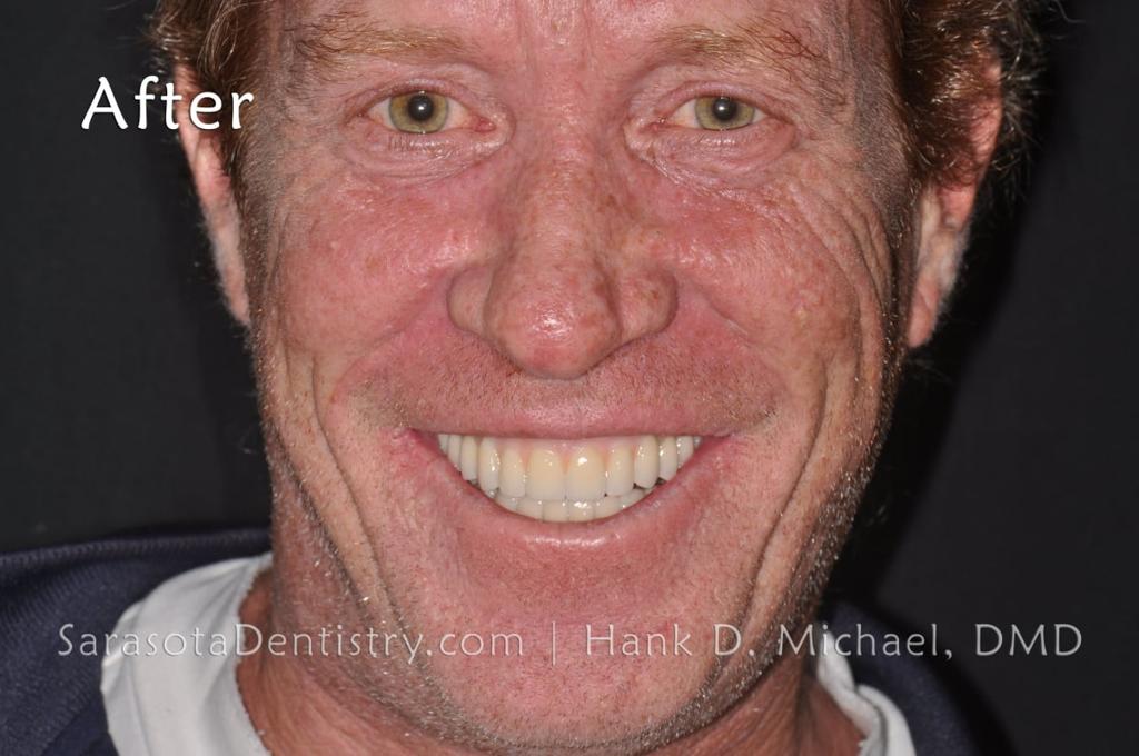 Full Arch Prettau Bridge Over 6 Dental Implants — view 1