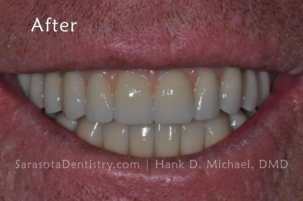 Full Arch Prettau Bridge Over 6 Dental Implants — view 3