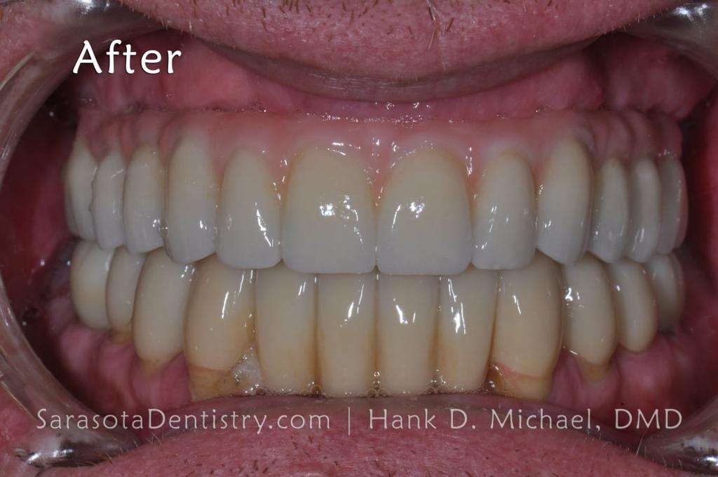Full Arch Prettau Bridge Over 6 Dental Implants — view 5