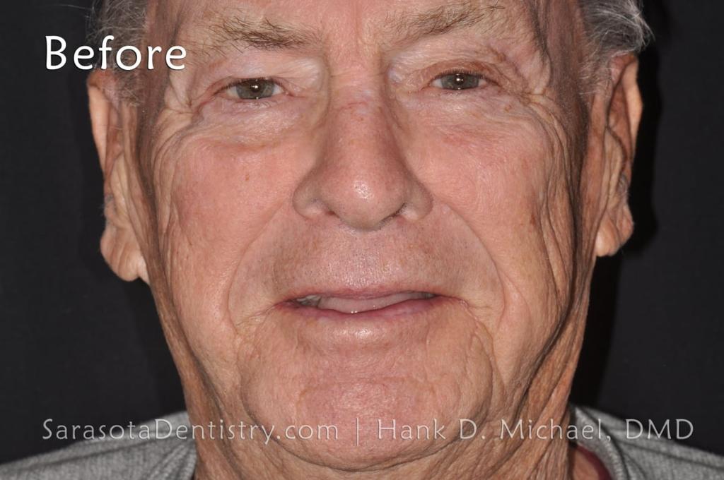 Full Arch Zirconia Dental Implant Restoration — view 2