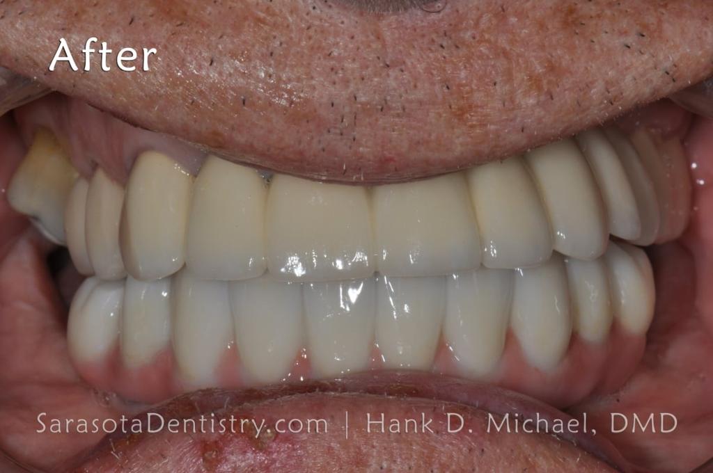 Full Arch Zirconia Dental Implant Restoration — view 6