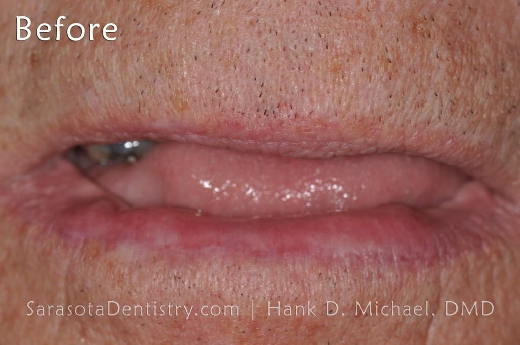 Full Arch Zirconia Dental Implant Restoration — view 3