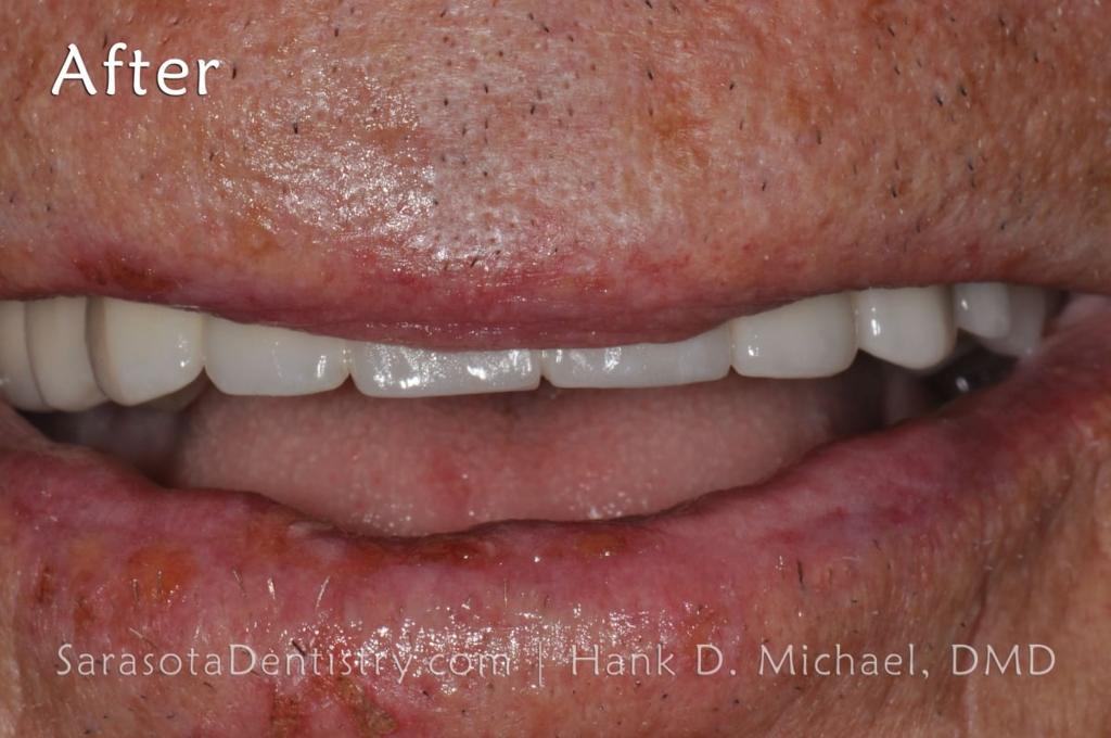 Full Arch Zirconia Dental Implant Restoration — view 4