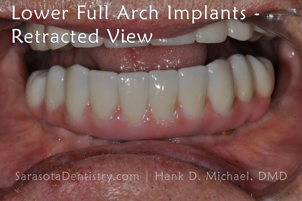Full Arch Zirconia Dental Implant Restoration — view 7