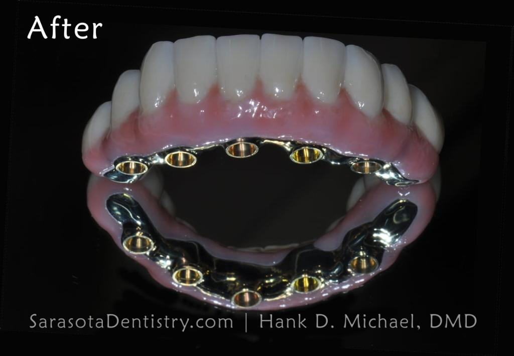 Full Arch Zirconia Dental Implant Restoration — view 8