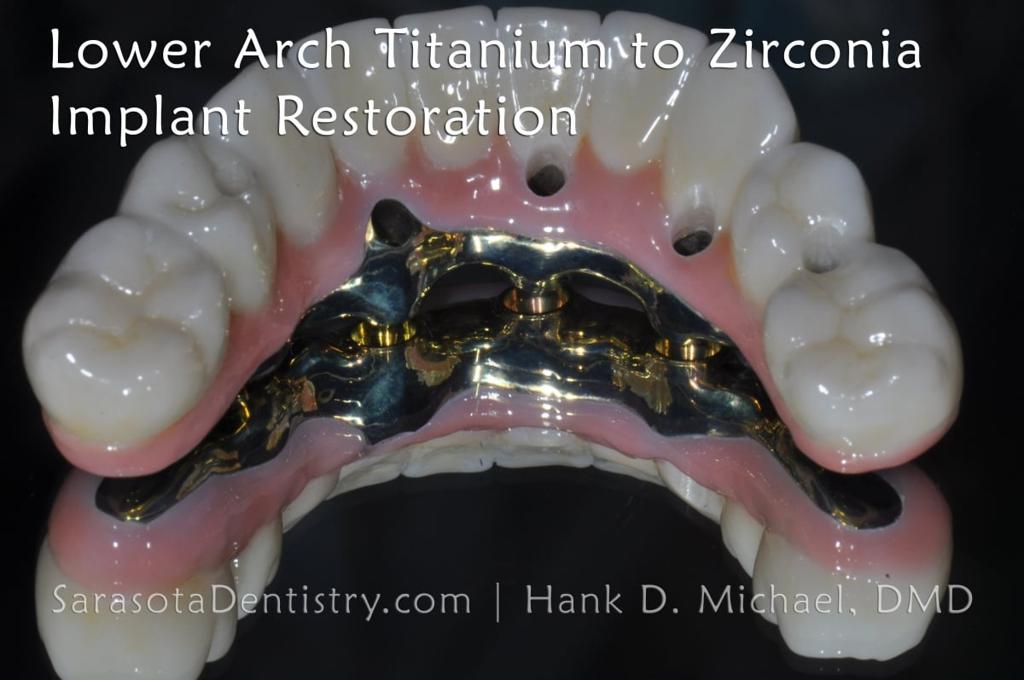 Full Arch Zirconia Dental Implant Restoration — view 9