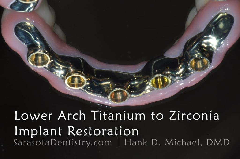 Full Arch Zirconia Dental Implant Restoration — view 10
