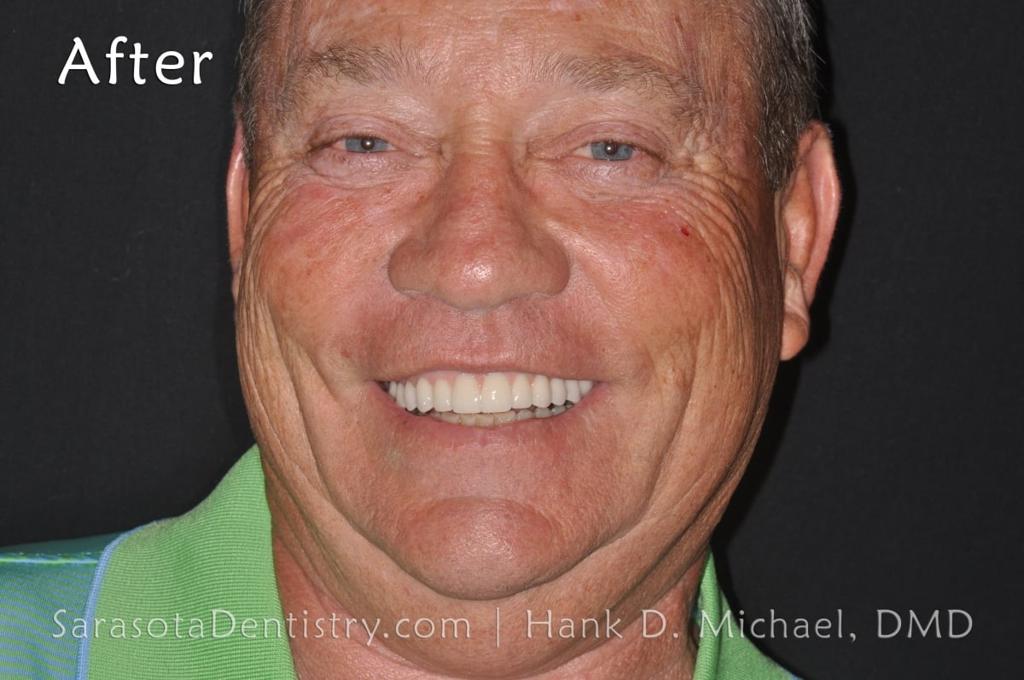 Full Arch Zirconia All on 6 Dental Implants Case — view 2