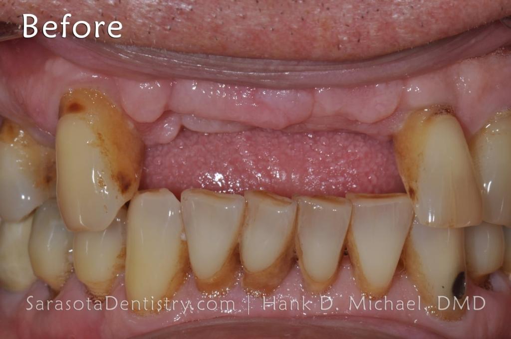 Full Arch Zirconia All on 6 Dental Implants Case — view 5