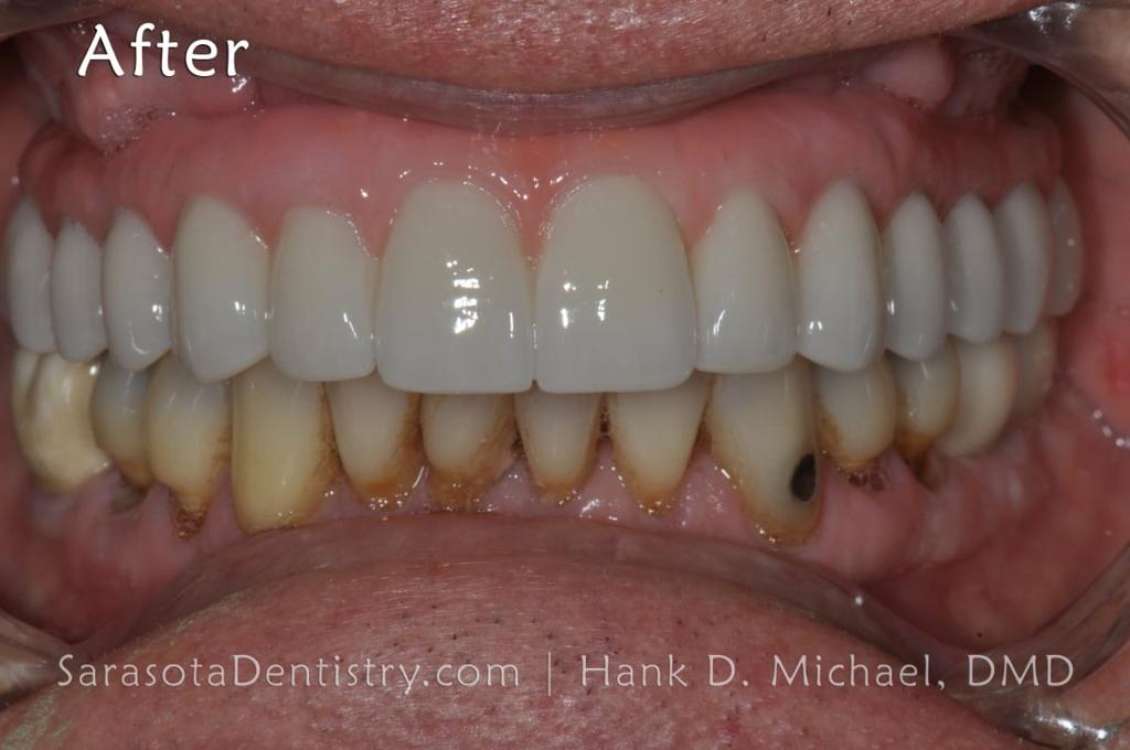 Full Arch Zirconia All on 6 Dental Implants Case — view 6