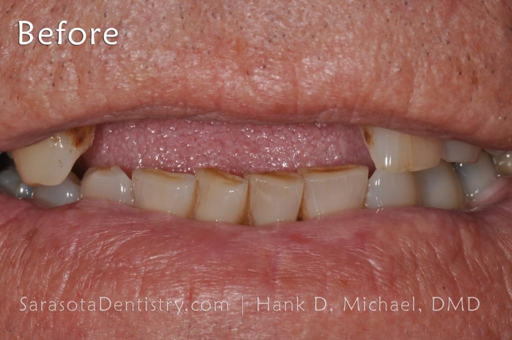 Full Arch Zirconia All on 6 Dental Implants Case — view 3